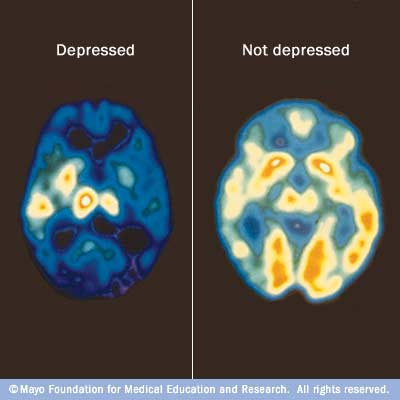 Depressed brain